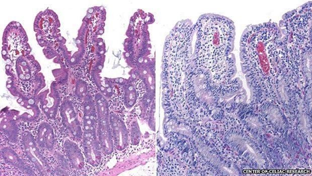 Vilosidades intestinais com aparência normal (esq.) e com as características de um celíaco  (Foto: BBC)