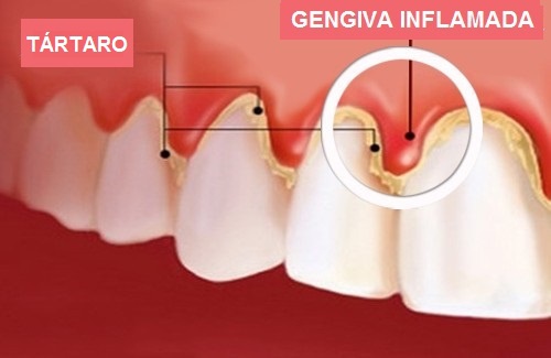 Tratamento natural para gengivite ou gengiva sangrenta